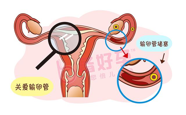 排卵正常却难怀孕，为什么呢？